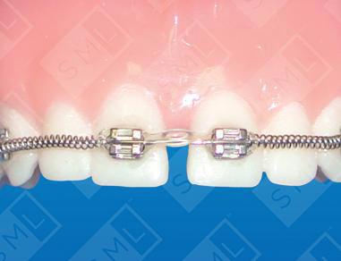 Diastema Closing U/L, Closing Space Appliance, Dental Tools | SML